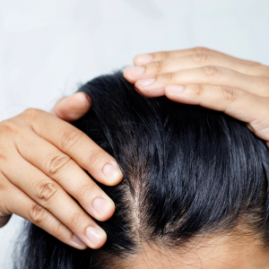 Rosemary Oil for Hair Loss